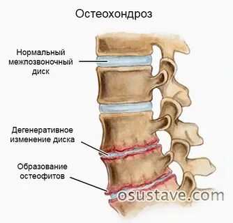 Остеофит народные средства
