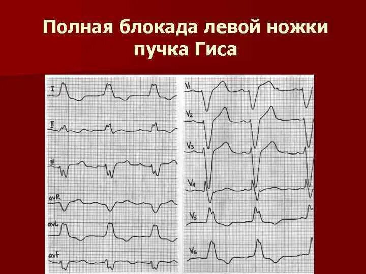 Блокада левой ножки пучка гиса на экг. Трехпучковая блокада ножек пучка. ЭКГ при полной блокаде левой ветви пучка Гиса. Блокада левой ножки пучка Гиса. ЭКГ при трехпучковой блокаде.