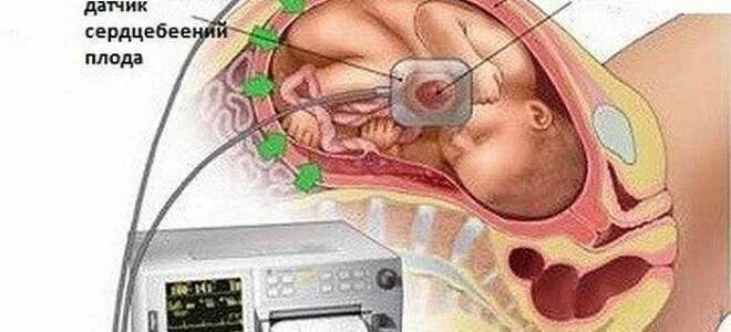 Можно почувствовать сердцебиение плода. Прослушивание сердцебиения плода. Сердцебиение плода на УЗИ. Брадикардия у плода при беременности. Брадикардия плода УЗИ.
