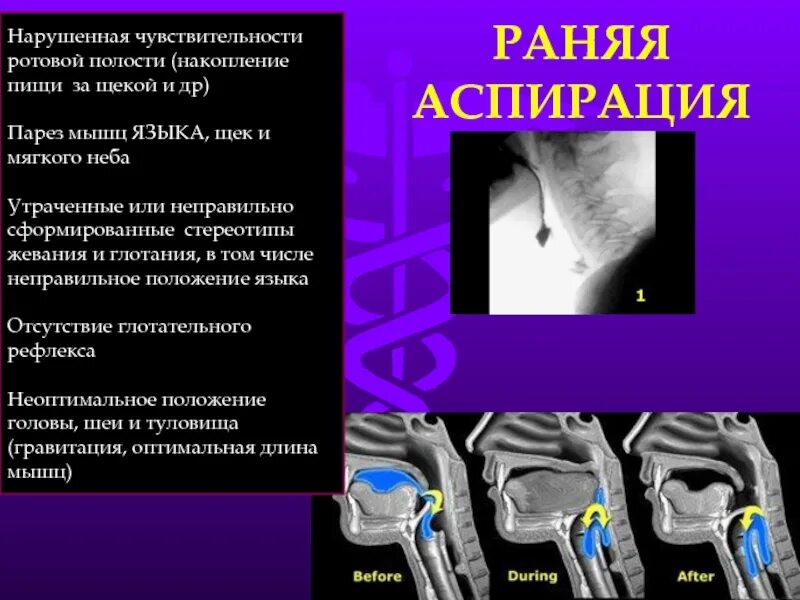 Нарушение глотательного рефлекса после инсульта. Восстановление функции глотания. Рефлекс глотания. Нарушение функции глотания.