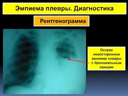 Эмпиема плевры
