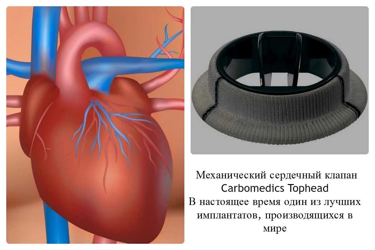 Замена клапана инвалидность