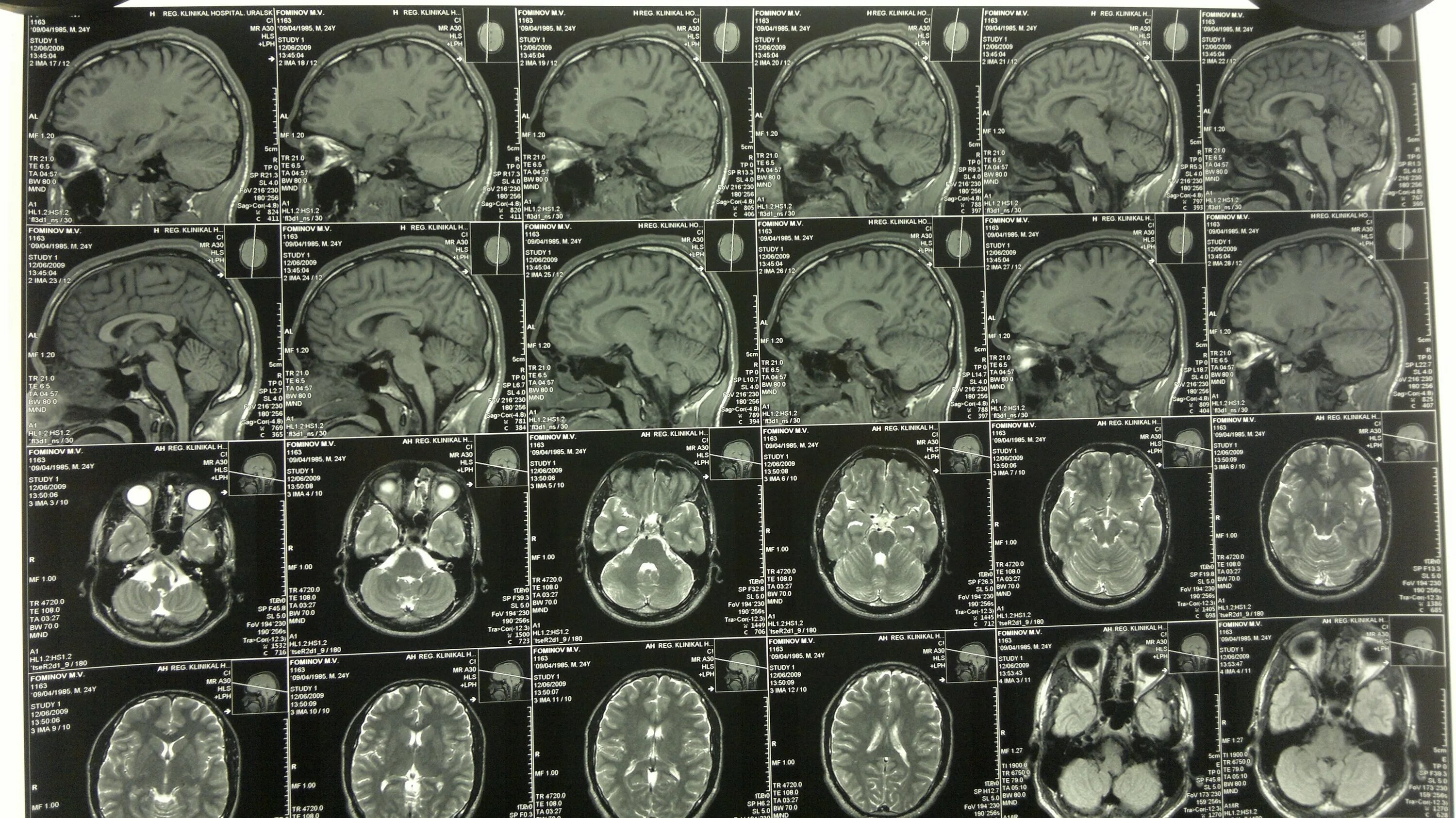 Мрт головы в новосибирске адрес. Ликворография головного мозга магнитно-резонансная. Снимок мрт головного мозга здорового человека. Магнитно-резонансная томография головного мозга обзорная. Рентген головного мозга здорового человека.