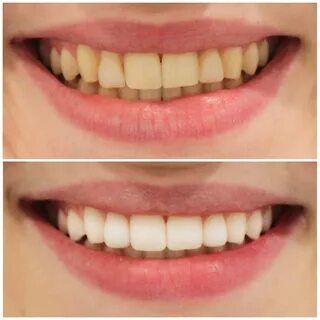 Smile after smile