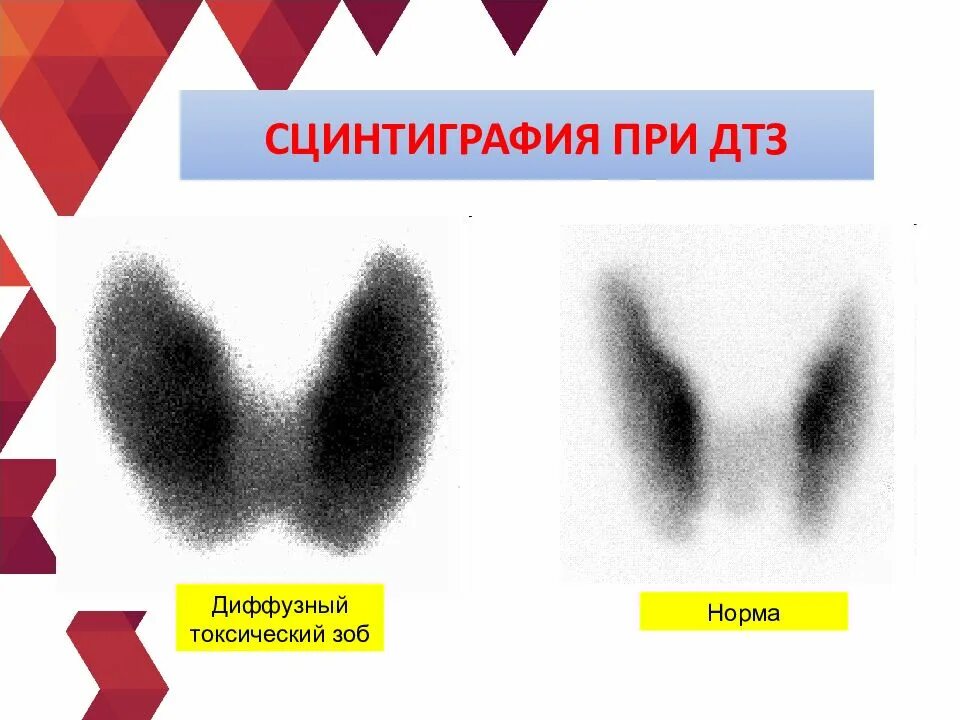 Диагностика зоба. Диффузный токсический зоб сцинтиграфия. Сцинтиграфия при диффузном токсическом зобе. Сцинтиграфия щитовидной железы ДТЗ. Холодный узел щитовидной железы сцинтиграфия.