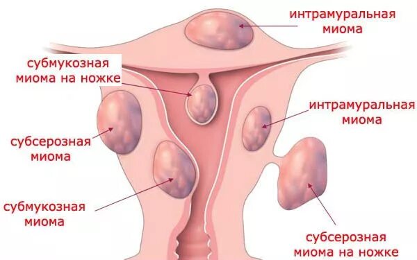 Формы миомы матки. Субмукозная миома узел. Множественная субсерозная миома матки. Субмукозная миома матки типы. Субсерозная узел миома матки.