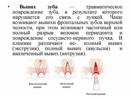 Люксация зуба