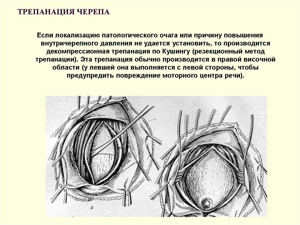 Костно-пластическая трепанация черепа. Трепанация черепа операции декомпрессивная. Первобытные трепанации черепа. Трепанация черепа показания. Трепанация черепа в древности.