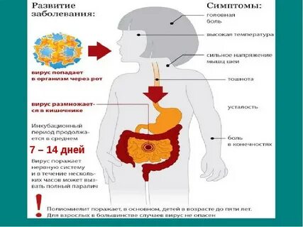 Симптомы полиомиелита у непривитых
