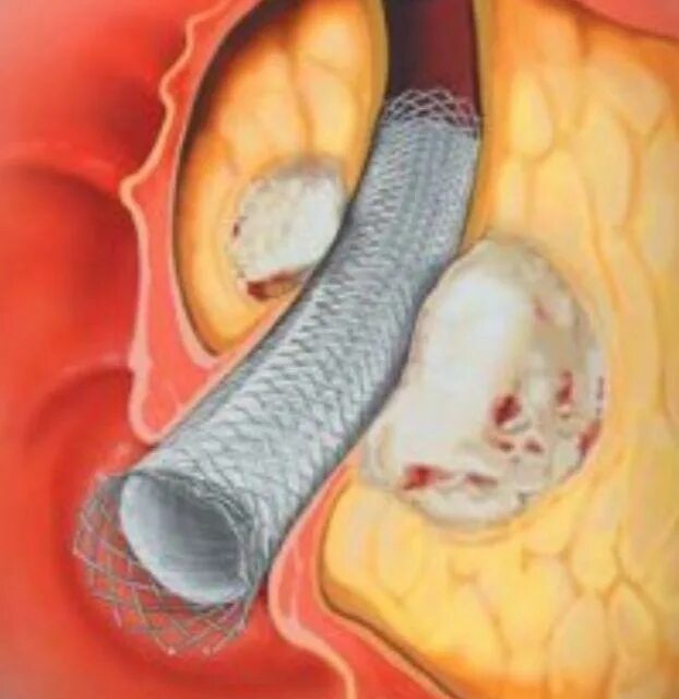 Эндоскопическое стентирование панкреатического протока. Стентирование вирсунгова протока поджелудочной железы. Стентирование желчного протока. Стент желчного протока