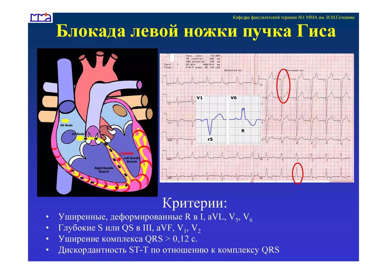 Признаки блокада левой ножки. Блокада левой ножки пучка Гиса на ЭКГ. Блокада левой и правой ножек пучка Гиса на ЭКГ. Блокада левой пучка Гиса на ЭКГ. Блок левой ножки пучка Гиса на ЭКГ.