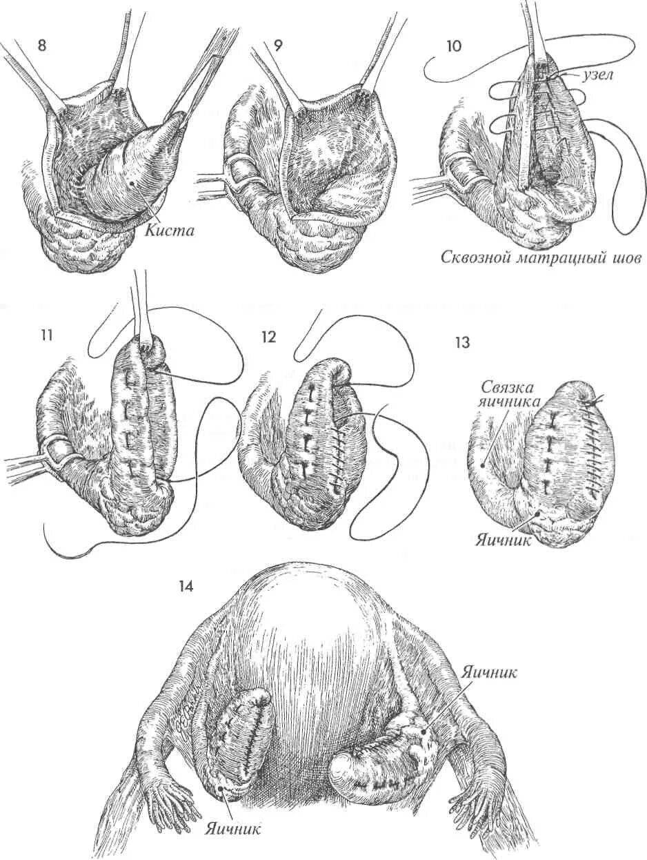 Женщины после удаления яичников отзывы. Цистэктомия кисты яичников. Цистэктомия резекция яичника. Операция резекция яичника ход операции. Цистэктомия яичника гинекологии.