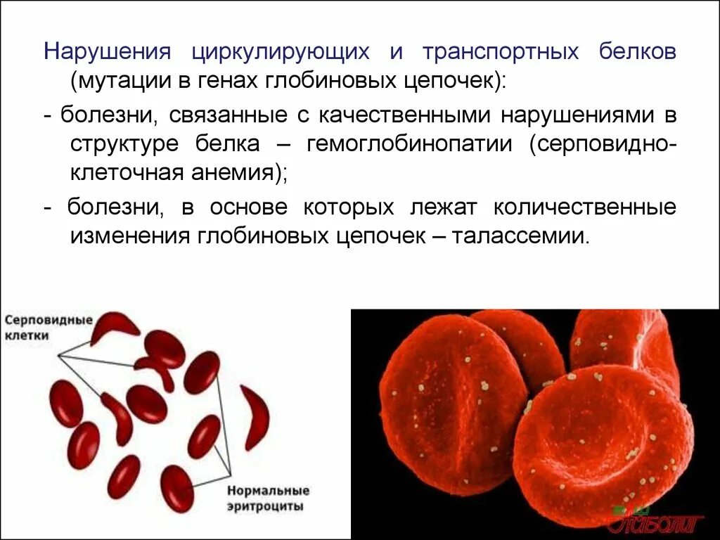 Серповидно клеточная анемия признаки. Патогенез серповидно клеточной анемии. Серповидно-клеточная анемия (s-гемоглобинопатия). Наследственные гемоглобинопатии серповидно клеточная анемия. Серповидноклеточная анемия мутация.