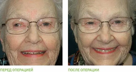 Как исправить косоглазие у взрослых. Операция по косоглазию. операция на косоглазие у детей. операция по косоглазию у взрослых. косоглазие до и после операции.