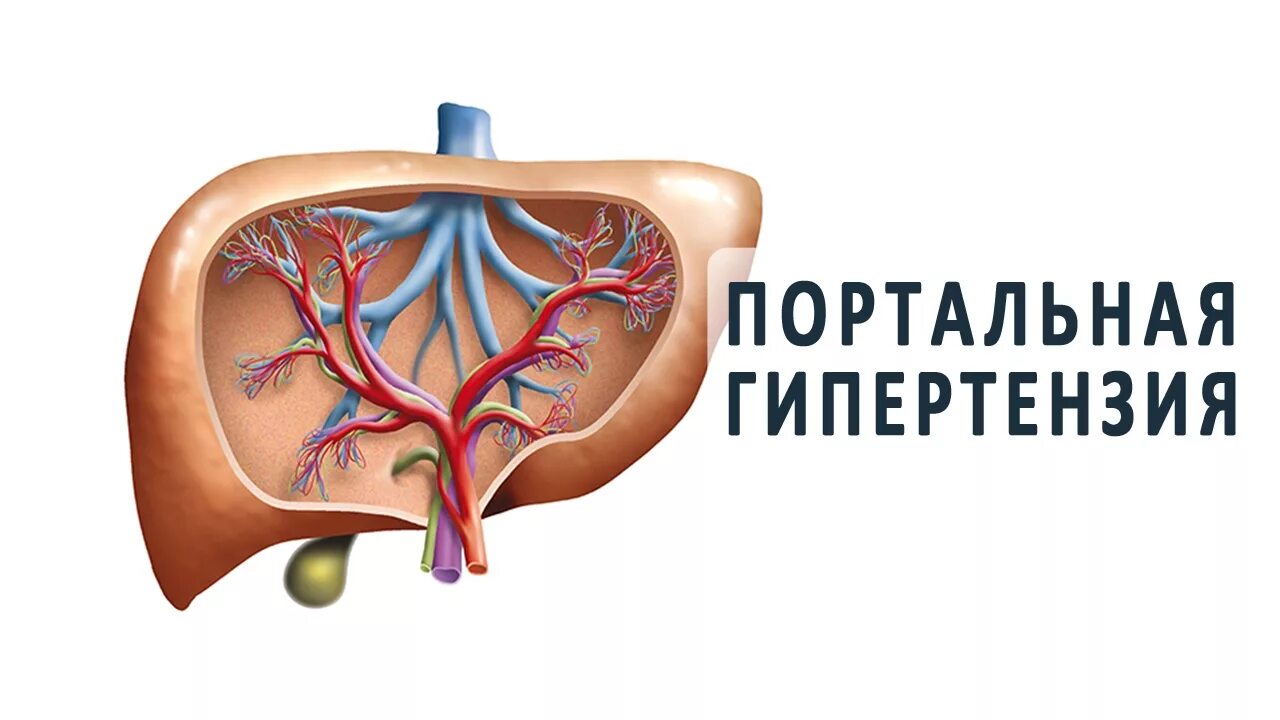 Тромбоз вен печени. Портальная Вена при циррозе печени. K76.6 портальная гипертензия. Внутрипеченочная портальная гипертензия. Предпеченочная портальная гипертензия.