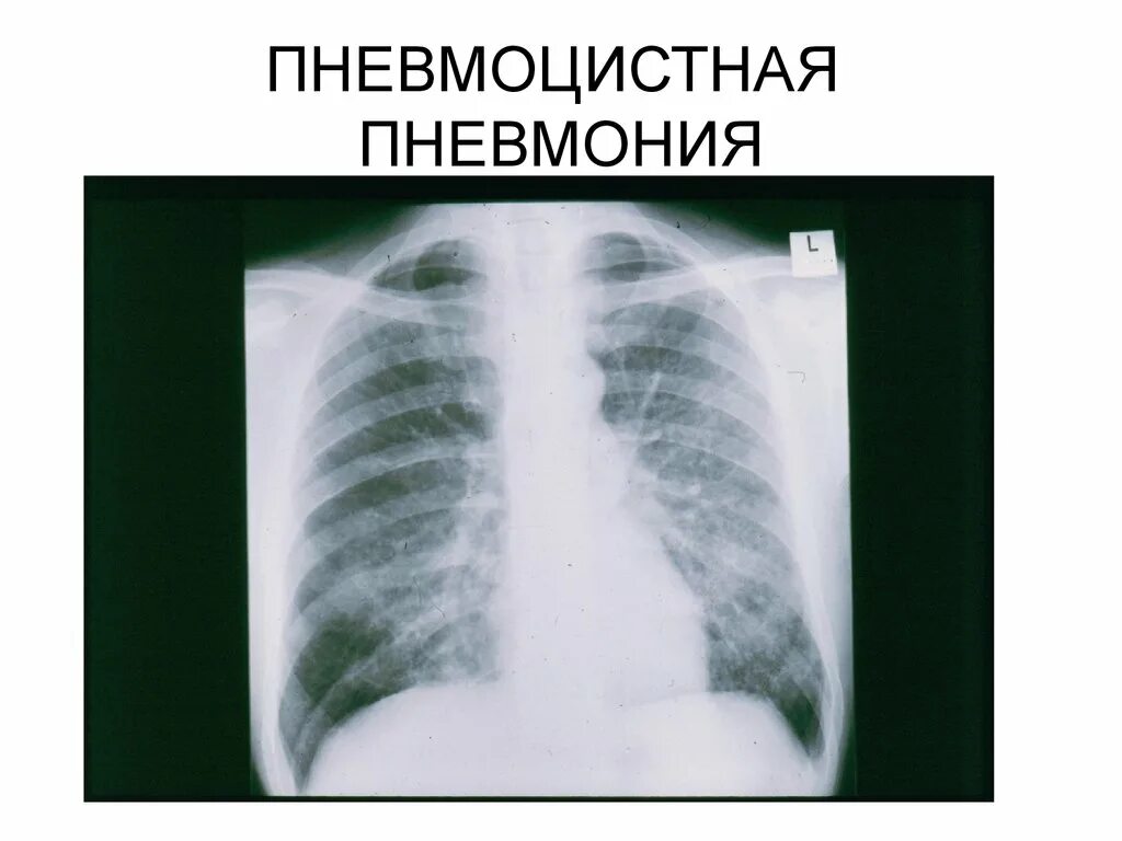 Пневмоцистная пневмония