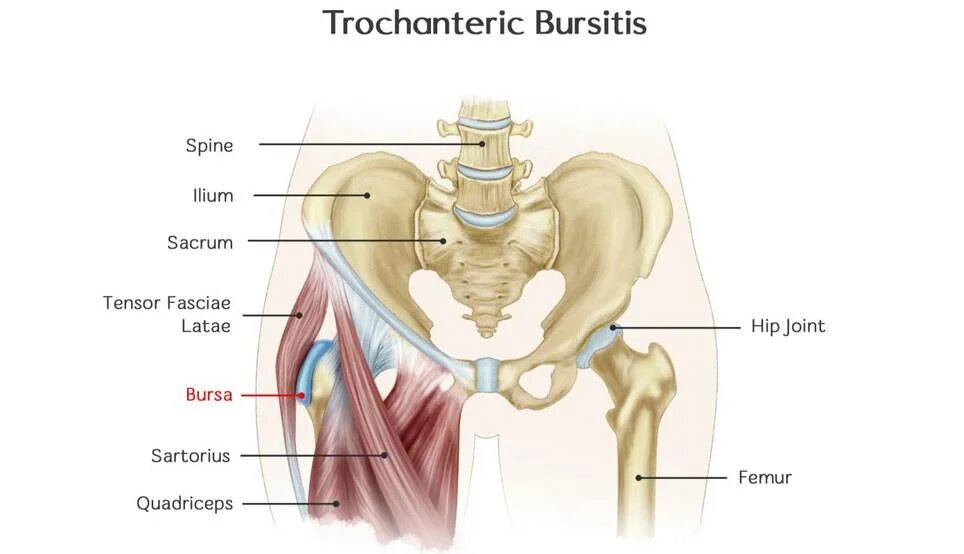 Лечение воспаление мышц тазобедренного сустава. Трохантерита тазобедренного сустава симптомы. Сумка большого вертела бедренной кости. Связка тазобедренного сустава трохантер. Вертельный бурсит тазобедренного.