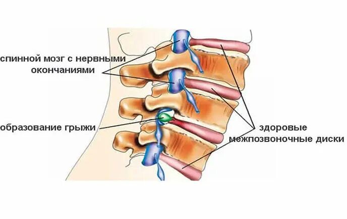Как лечить шейную грыжу
