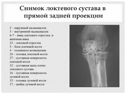 Локтевой сустав анатомия рентген