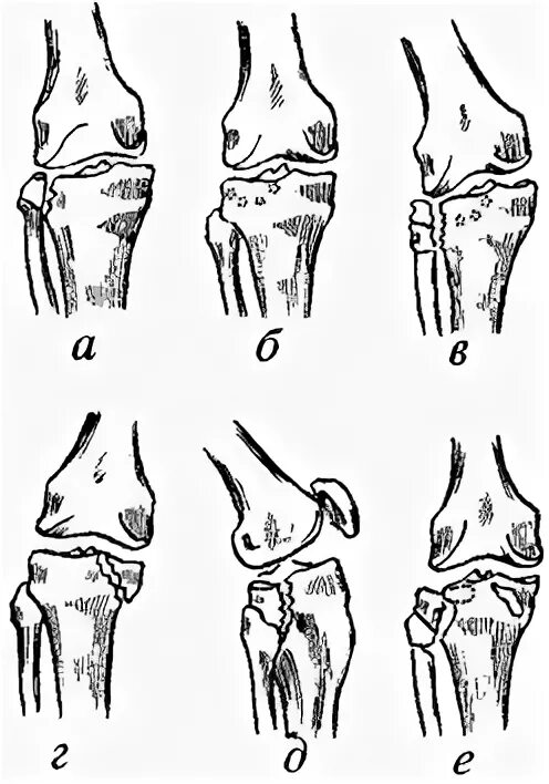 Чрезмыщелковый перелом большеберцовой кости. Компрессионный перелом большеберцовой кости. Внутрисуставной перелом латерального мыщелка большеберцовой кости. Импрессионный перелом мыщелка.
