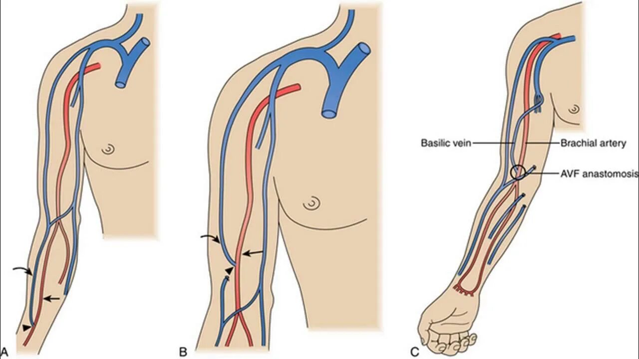 Пункция артериовенозной фистулы для гемодиализа. Артерия венозная фистула. Как выглядит шунт