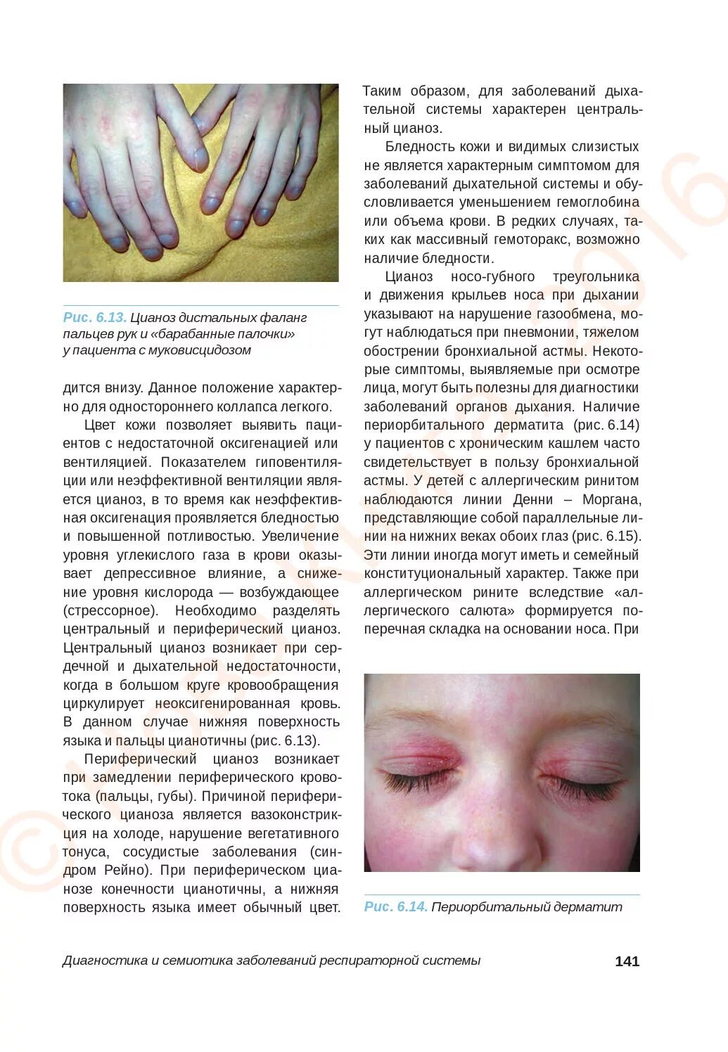 Цианоз при каких заболеваниях. Периорбитальный цианоз у детей. периорбитальный и периоральный цианоз. периорбитальный дерматит.