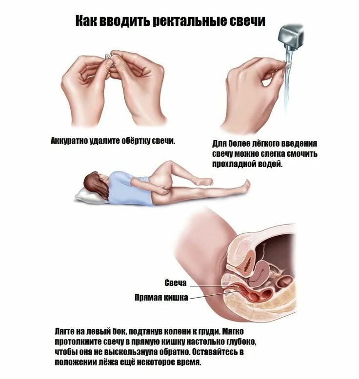 Действие свечей. Как правильно вставлять свечку ректально. Ректально свечи в прямую кишку. Как вводить свечи ректально.