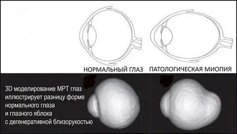 Патологическая миопия