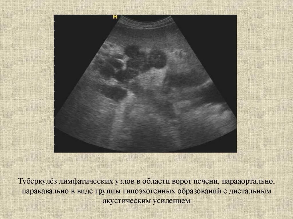 Мезентериальные лимфатические узлы в брюшной полости УЗИ. Парааортальные лимфатические узлы на УЗИ. Лимфаденопатия ворот печени УЗИ. УЗИ лимфатических узлов брюшной полости. Увеличенные лимфоузлы в печени