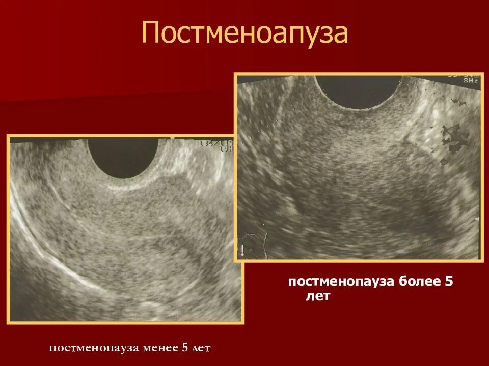 Почему в постменопаузе. Эндометрия в постменопаузе. Патология эндометрия в постменопаузе.