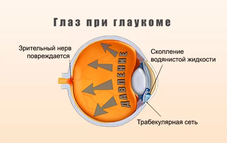 Глазное давление при катаракте. Причины глаукомы глаукома. Глаукома памятка для пациентов. Профилактика глаукомы глаза.