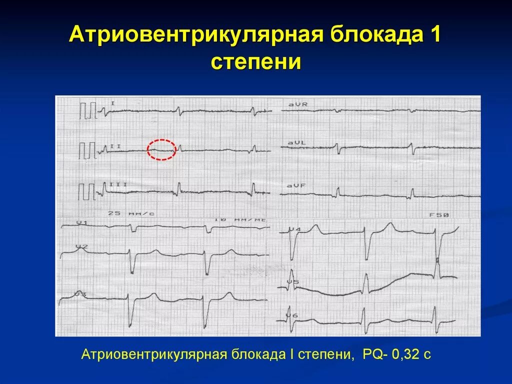 Полная атриовентрикулярная блокада. АВ блокада 1 степени на ЭКГ. А-В блокада 1 степени на ЭКГ. Блокада на ЭКГ АВ блокада 1 степени. Ab блокада 1 степени ЭКГ.