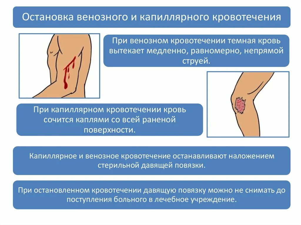 Метод остановки капиллярного кровотечения. Остановка венозного и капиллярного кровотечения. Остановка венозного кровотечения. Способы остановки венозного кровотечения. Эффективный и доступный метод остановки венозного