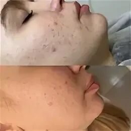 Акне 2023. Olga косметика. Сыворотка от прыщей и следов от них. Ceraclinic intensive cream. Акне 2023.