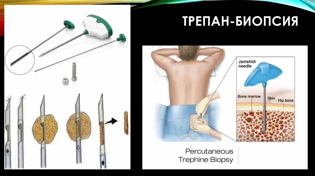 Трепанобиопсия молочной железы что это. Пункционная аспирационная биопсия. Трепанобиопсия костного мозга. Трепан пункция костного мозга. Эксцизионная биопсия узла.