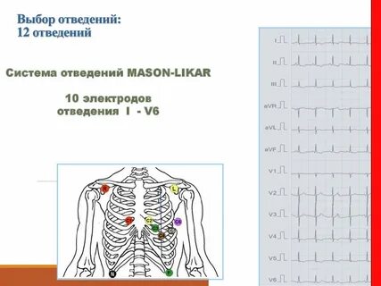 Экг как ставить по цветам