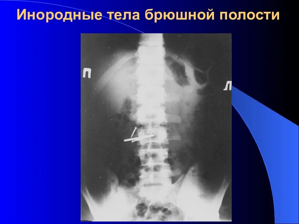 Инородное тело брюшной полости после операции