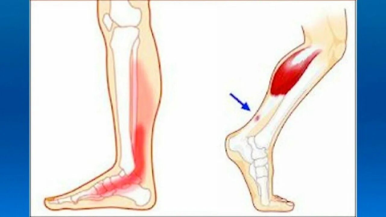 Боли голени пятки. Тендинит ахиллова сухожилия. Воспаление ахиллова сухожилия. Ахиллово сухожилие воспаление. Тендопатия ахиллова сухожилия.