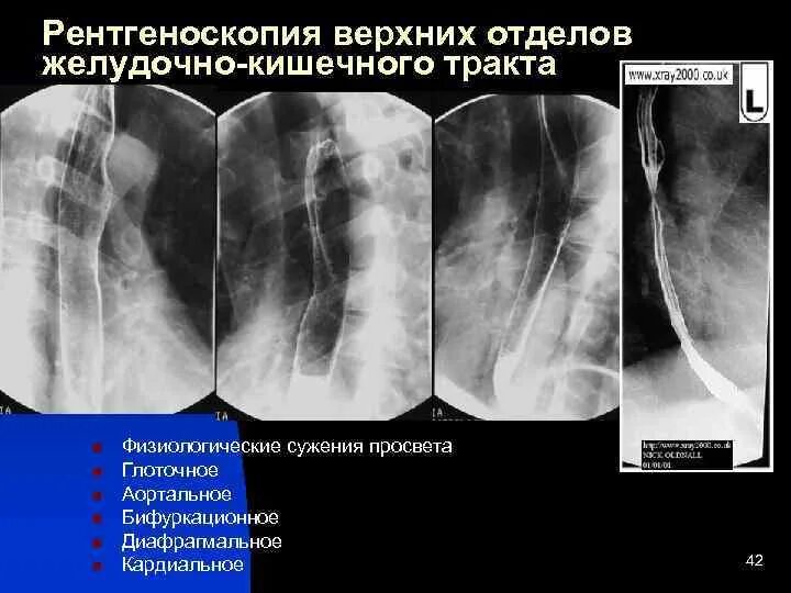 Рентгеноскопия жкт. Рентгенография верхних отделов жкт. рентгеноскопия. рентгеноскопия органов жкт. рентгеноскопия верхних отделов пищеварительного тракта.