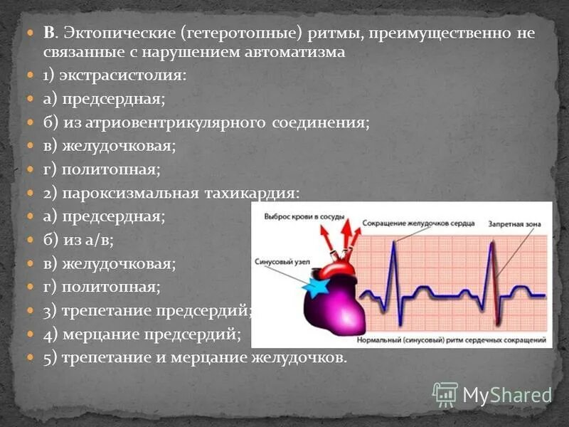 Эктопический предсердный ритм что это