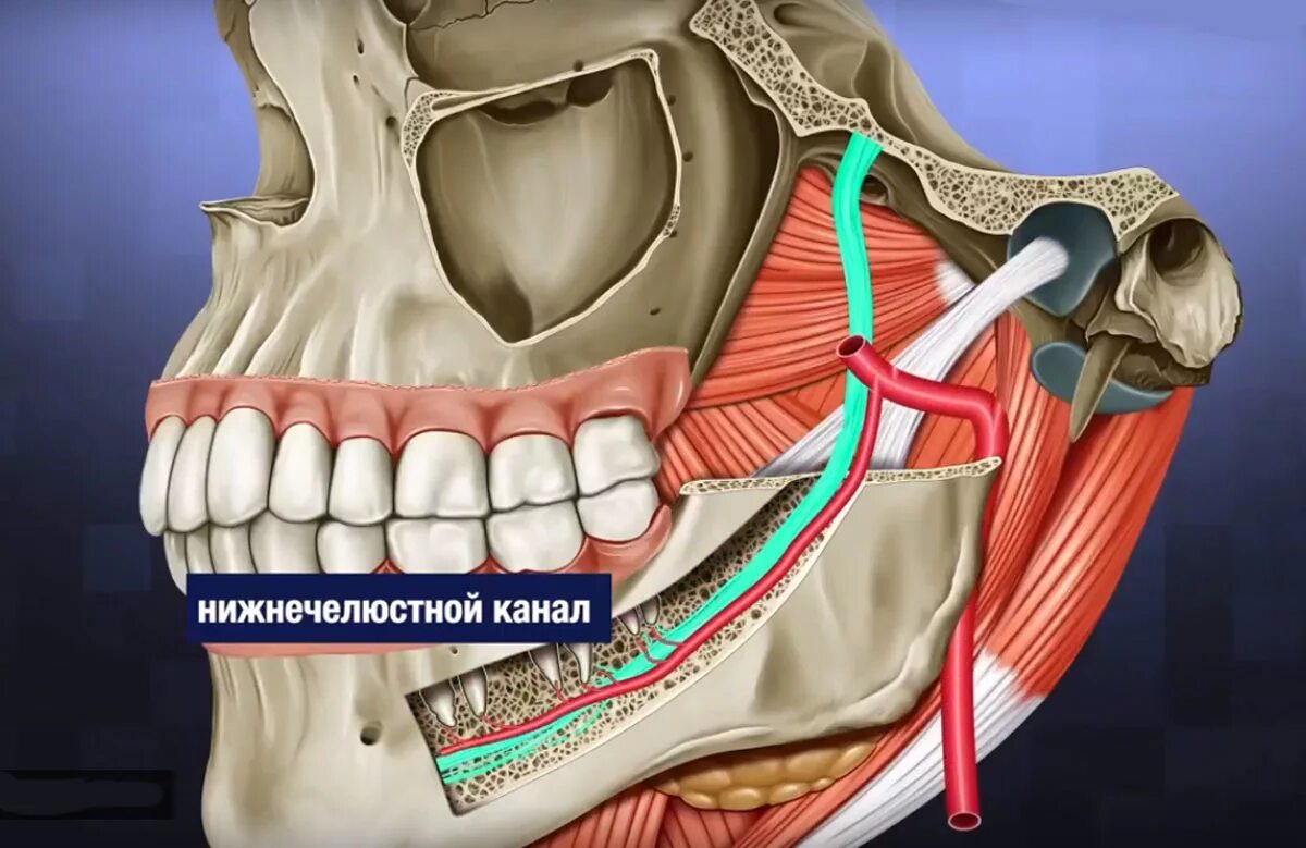 Топография нижнелуночкового нерва. Повреждение нижнечелюстного нерва имплантатом. Топография нижнечелюстного канала.