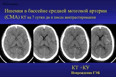 Бассейн средней мозговой артерии
