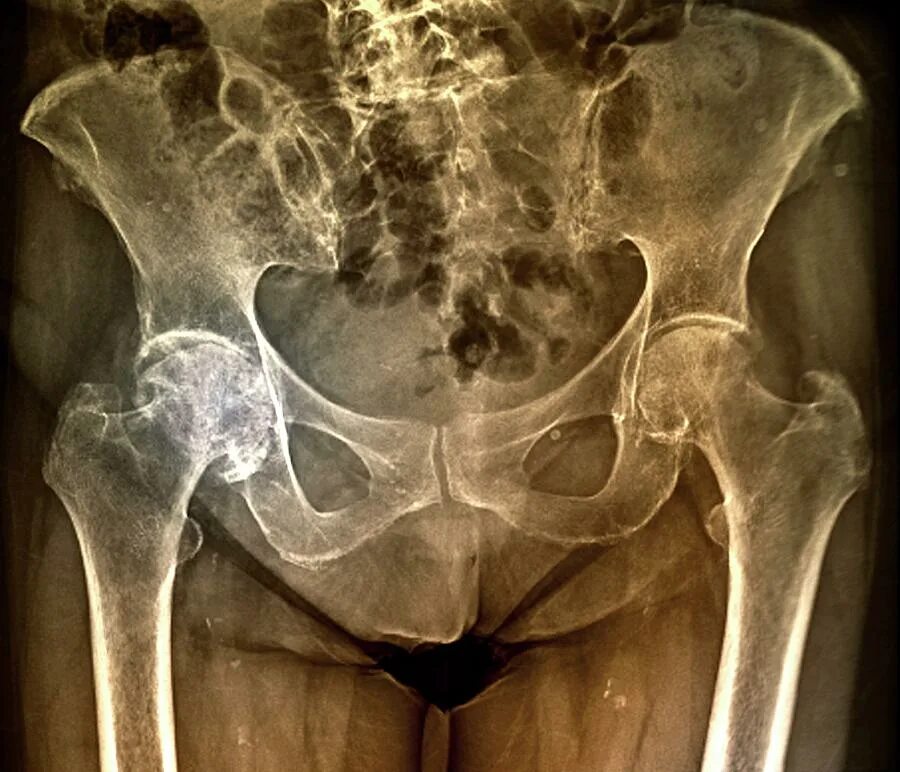 Коксартроз тазобедренного сустава 4. Коксартроз тазобедренного сустава симптомы. Артроз тазобедренного сустава форум. Артроз тазобедренного сустава. Артроз тазобедренного сустава мкб.