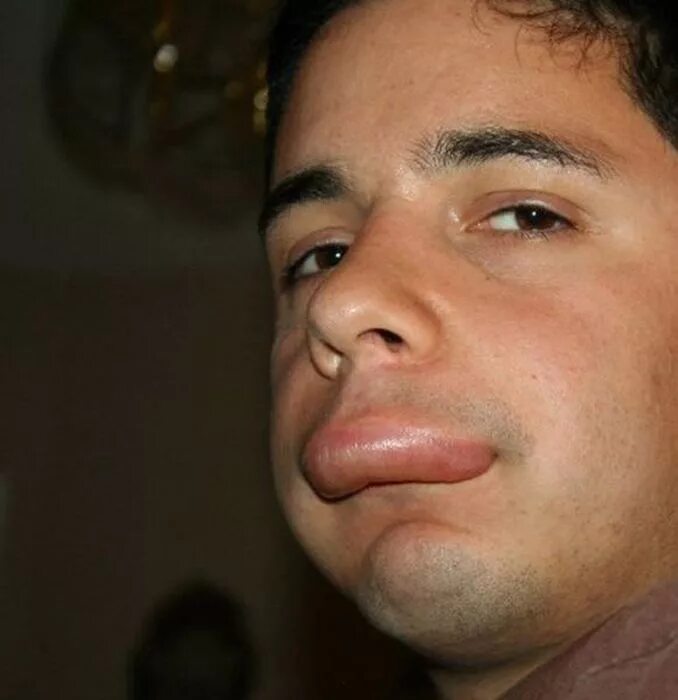 Шмели шершни оводы. Человек укус пчелы. Человекьс большой нижней губой. Человек укус пчелы. Пчеловод василий.