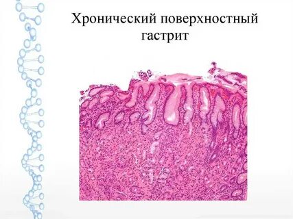 Слизистая атрофична