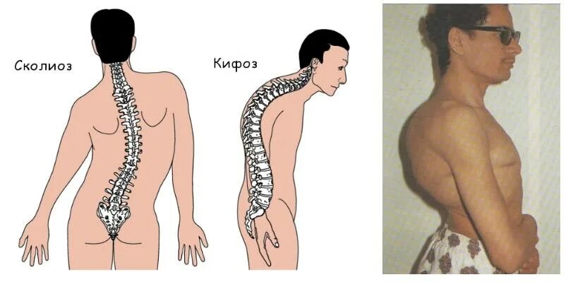 Круглая спина (тотальный кифоз). Грудной кифоз 3 степени. Кифоз позвоночника 2 степени. Степени кифоза. Выраженный кифоз грудного отдела позвоночника.
