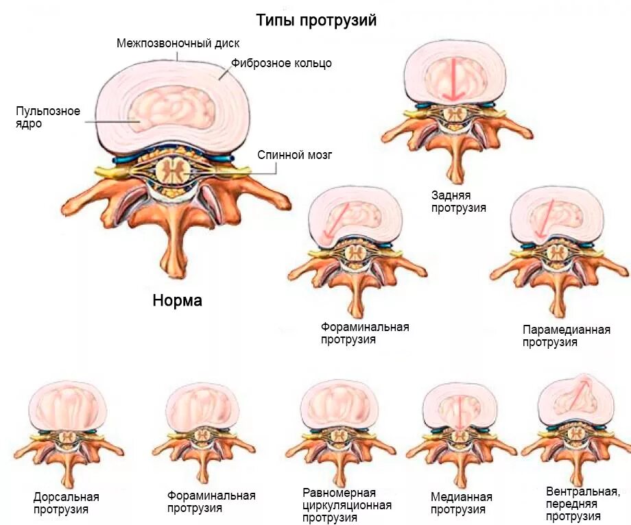 Диффузное выбухание межпозвоночного. Дорзальная диффузная протрузия межпозвонкового диска l5-s1. Протрузии диска l5-s1. Классификация грыж позвоночника по локализации. L4-5 задняя циркулярная протрузия.