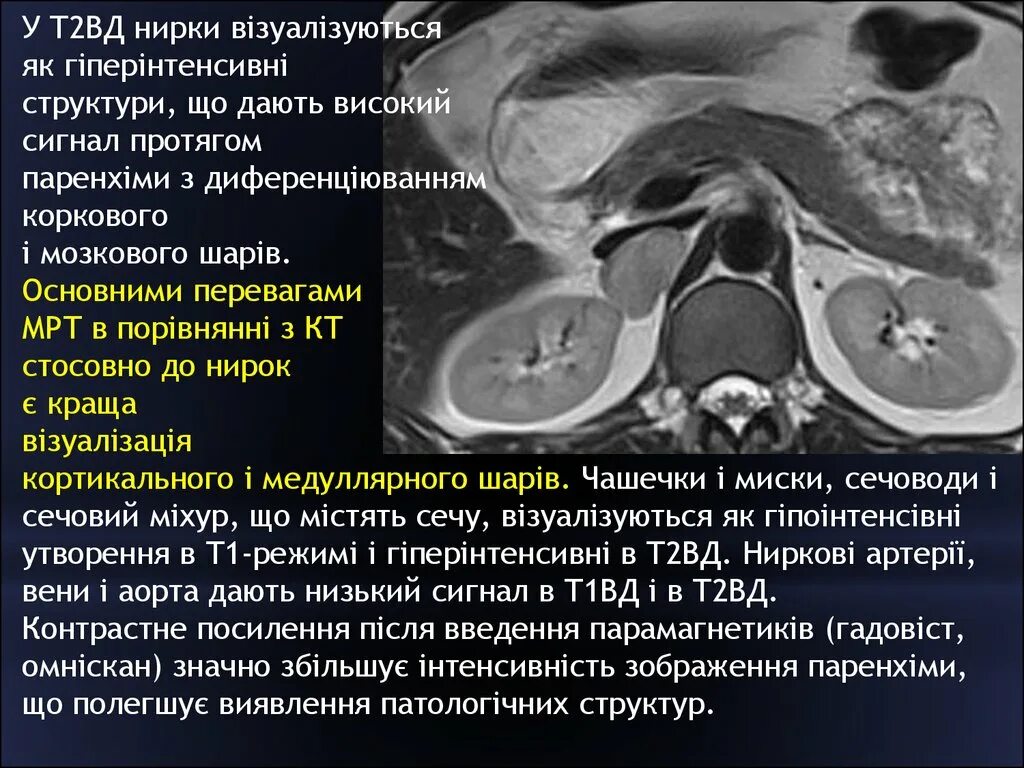 Т2 гипоинтенсивный. Т2 взвешенное изображение. гипоинтенсивный сигнал мрт на т2 ви. гиперинтенсивный сигнал на т2.
