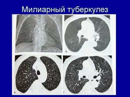 Диссеминированный кавернозный туберкулез