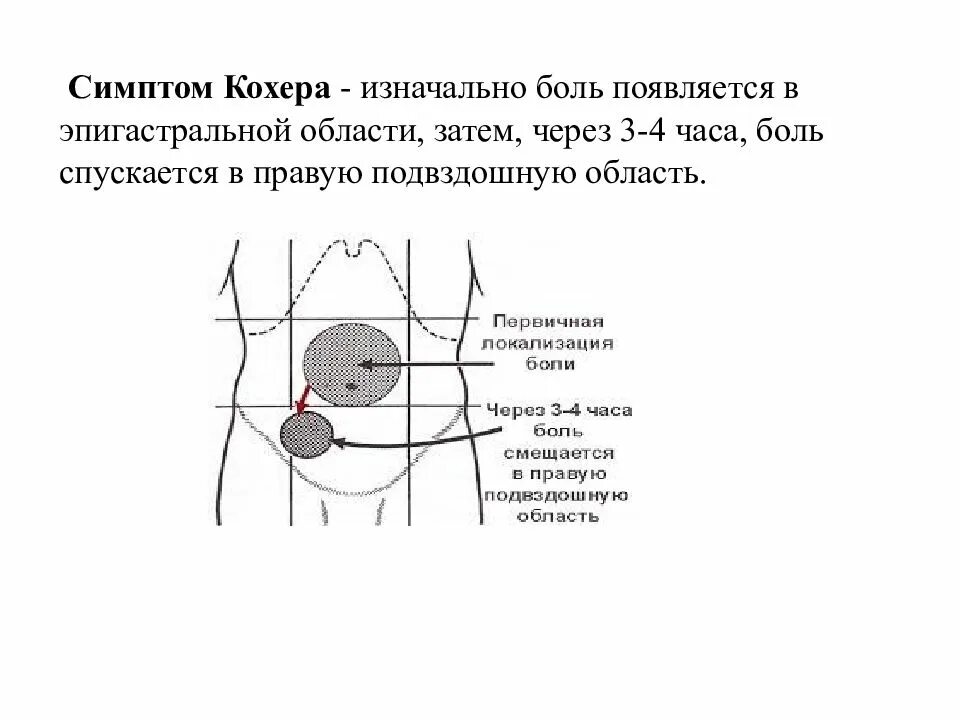 Кохер аппендицит. Симптом кохера-Волковича. Острый аппендицит симптом кохера. Синдром кохера Волковича при аппендиците. Острого аппендицита - симптомы Волковича.